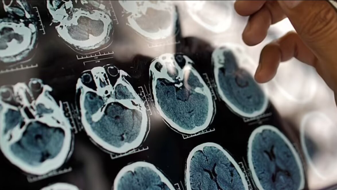 ببینید | تشخیص آلزایمر ۲۰ سال زودتر