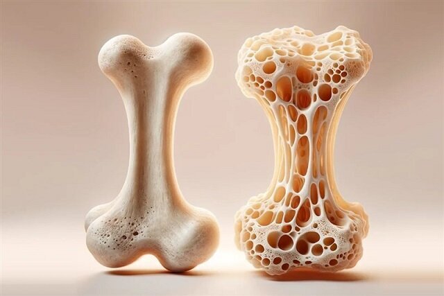 مصرف این ویتامین‌ها از پوکی استخوان جلوگیری می‌کنند