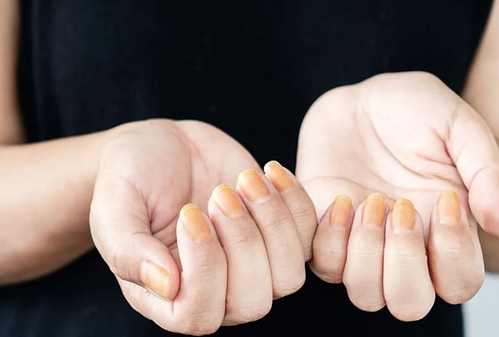 رنگ زرد ناخن نشانه چیست؟ رنگ زرد ناخن نشانه چیست؟