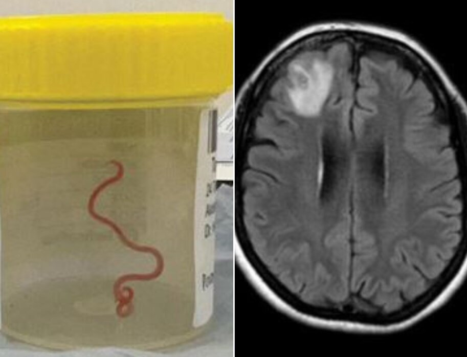 خارج کردن کرم ۱۸ سانتی‌متری از مغز یک مرد/ عکس
